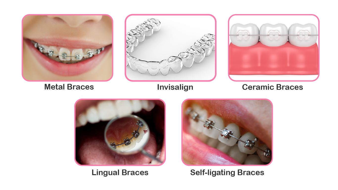 dental braces Thousand Oaks CA